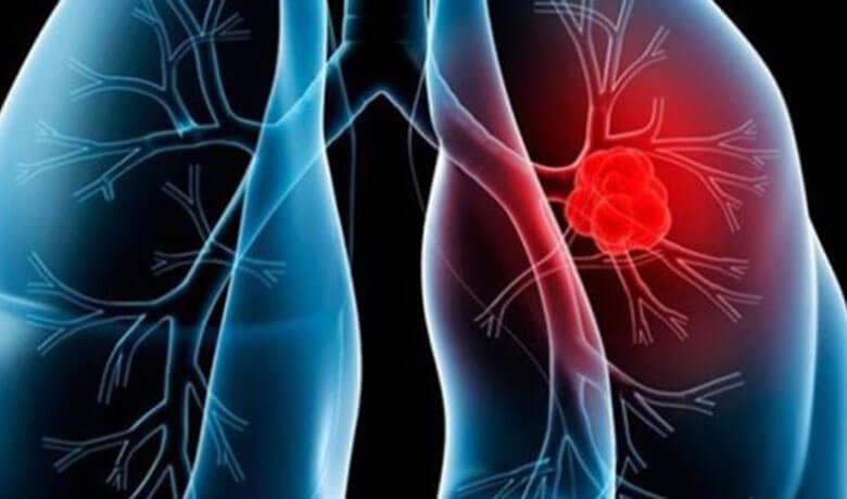 Types of Lung Cancer