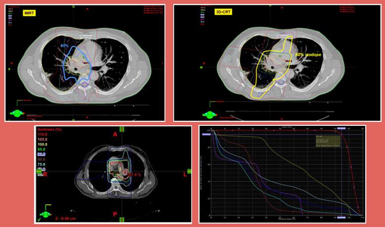 Radiation Therapy