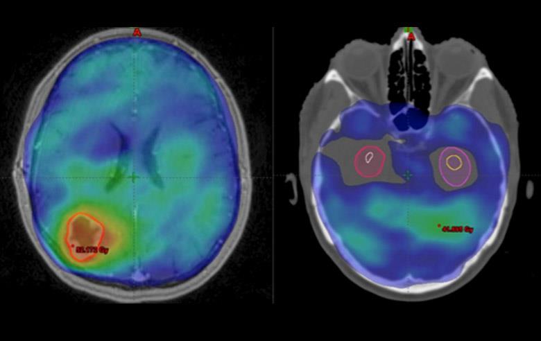 Healing with radiotherapy of tension