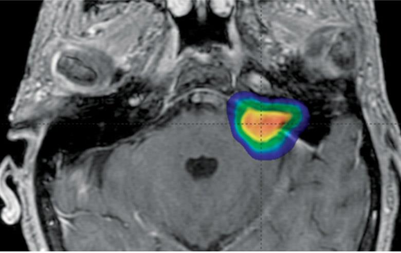 Treatment with stereotactic radiosurgery