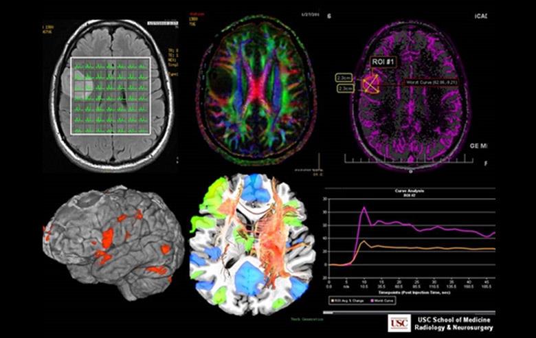 MRI spectroscopy & perfusion