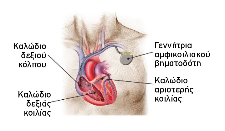 Αμφικοιλιακός βηματοδότης