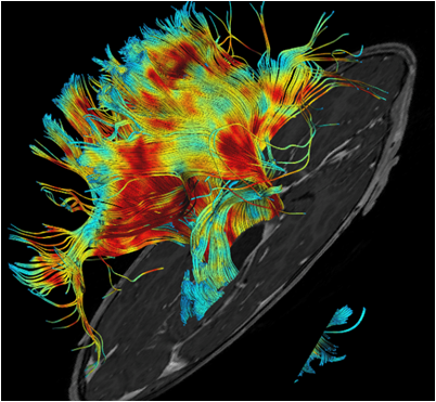 DTI-tractography