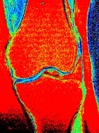 CARTILAGE MAPPING (T2 MAPPING)