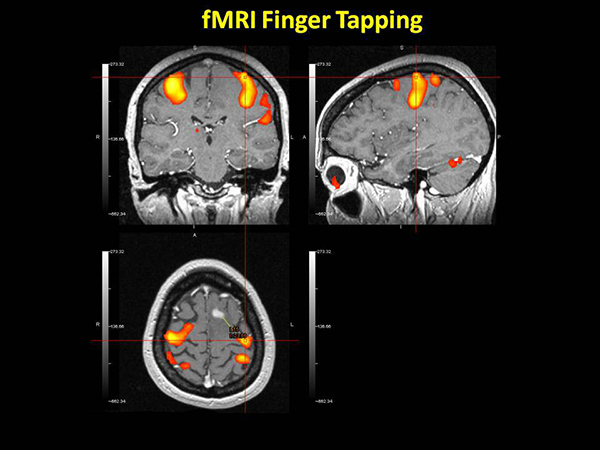 FUNCTIONAL MRI (fMRI)