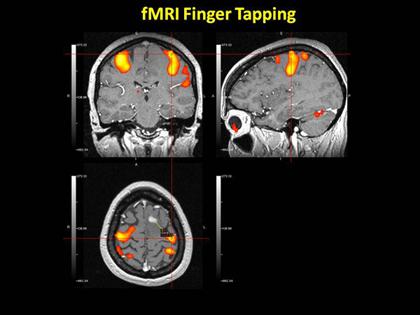 ΛΕΙΤΟΥΡΓΙΚΗ ΜΑΓΝΗΤΙΚΗ ΤΟΜΟΓΡΑΦΙΑ (fmri)