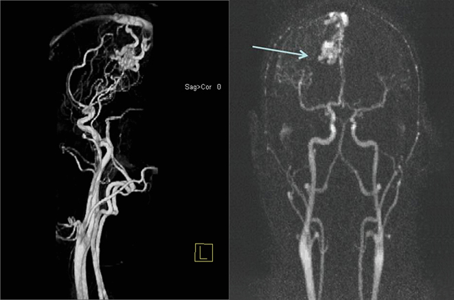 DYNAMIC MR ANGIOGRAPHY